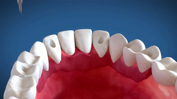 dentalprosthesis.mov