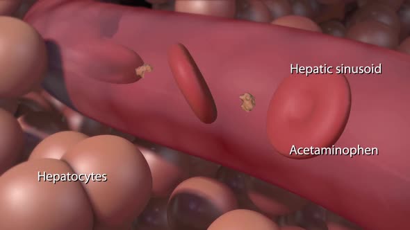 Plaque formation in the cardiovascular tract, cholesterol