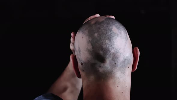 Hospital patient with bald head in chemotherapy session, rubbing head in dark room, close up