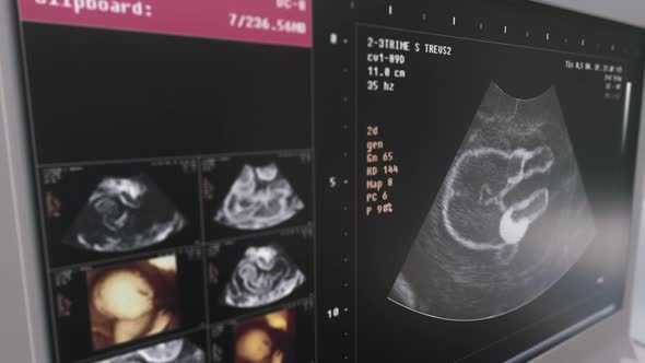 Prenatal Analysis Equipment Determines Baby Boy Gender By Ultrasound Scan alt