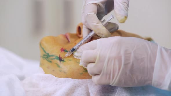 Picture of Surgeon Making Injection in Face with Markings of Adult Woman 50S60s Lying on Operating