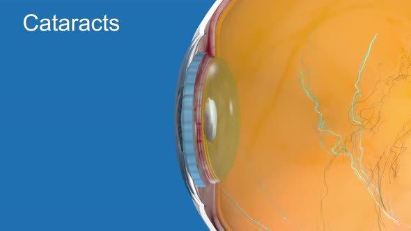 3D Medical Animated eye anatomy cataract on blue background