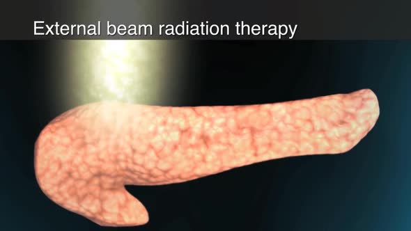 Radiotherapy is the treatment of cancer using ionizing radiation.