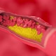 Red Blood Cells Flow Through the Vessel Affected By Cholesterol Plaque - VideoHive Item for Sale