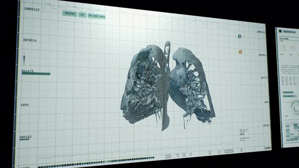Modern computed tomography of lung injuries. 3D model of pneumonia. COVID-19 alt