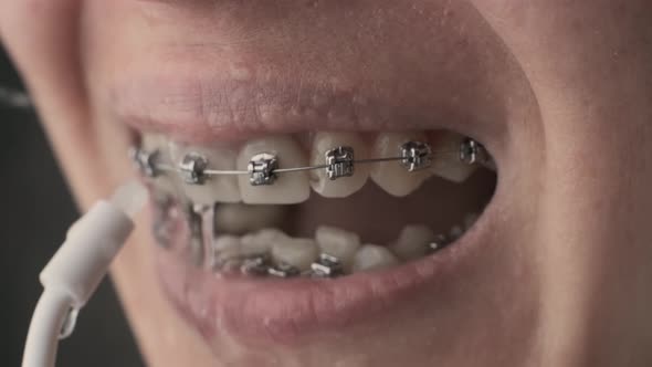 Closeup Teeth with Braces and an Irrigator