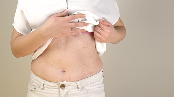 Women with symptoms of itchy urticaria or allergic reaction on the skin