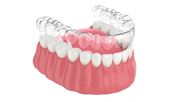 Invisalign removable and invisible retainer placement on lower jaw over white background
