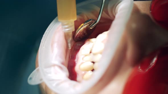 Close Up of Anesthetic Getting Injected Into Patient's Gums