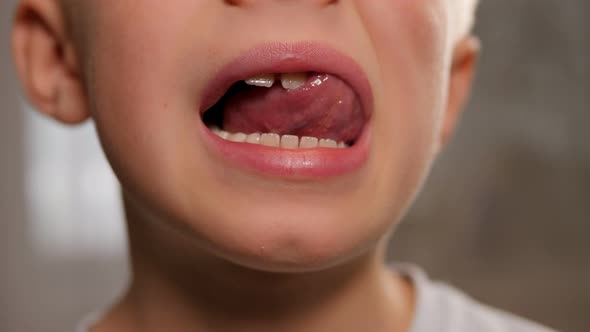 A Little Boy's Face with His Mouth Open He Shows His Changing Teeth