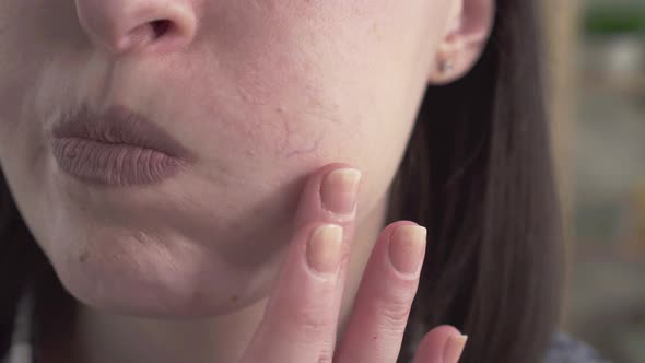 Close Up Rosacea on the Woman's Face