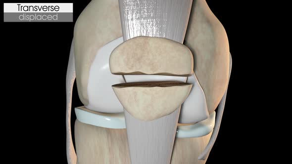 Patella Fracture   Transverse Displaced