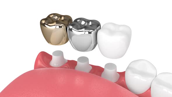 Teeth in jaw with three different types of dental crown filling