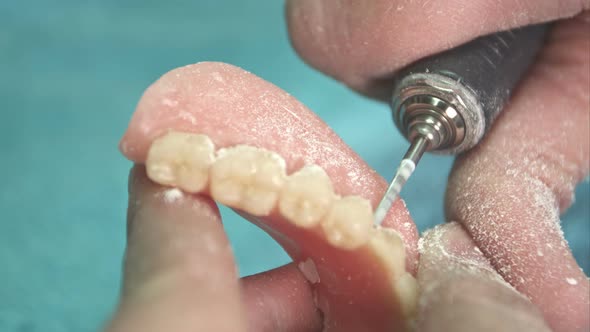 Dentist Makes a Dental Implant Prosthesis Made of Plaster Cast