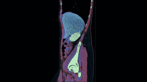 Contrast MRI of the Abdominal Cavity, Gastrointestinal Tract, Bladder