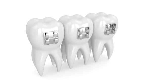 Teeth with dental orthodontic braces