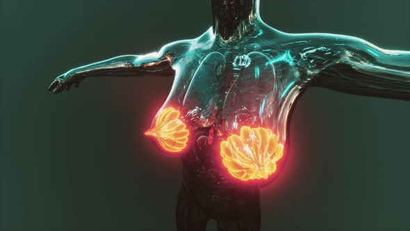 Female Breast with Cancer Focus of Inflammation alt