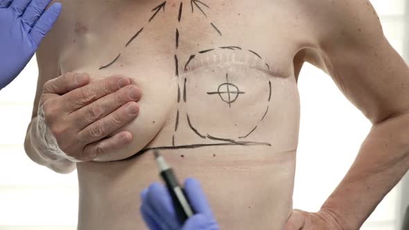 Preparing for Breast Reconstruction for a Woman Undergoing Mastectomy