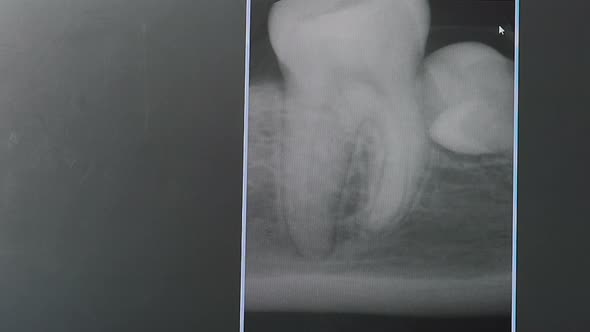 Dentist Discussing with Patient Bad Teeth Xray Pointing with Finger