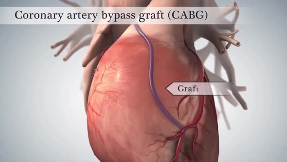 Coronary artery bypass surgery is done using a healthy blood vessel called a graft.