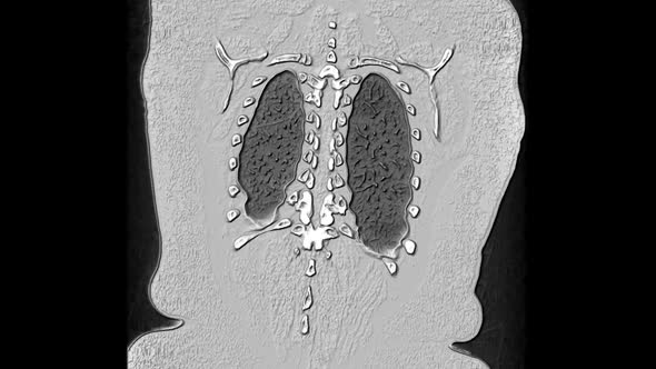 3D Black and White MRI Scan of The Lungs and Bronchi, Diagnosis of Respiratory Diseases