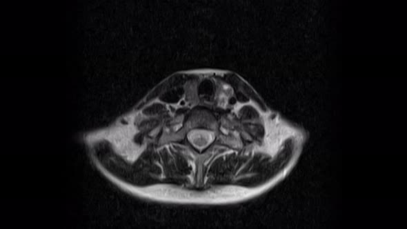 MRI of the Cervical Spine, Detection of Protrusions and Hernias