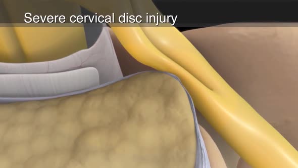 Occasionally, a spinal nerve root is subjected to compression or irritation due to several factors.