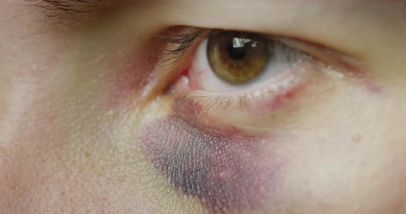 The Eye of a Man with a Bruise and Abrasions