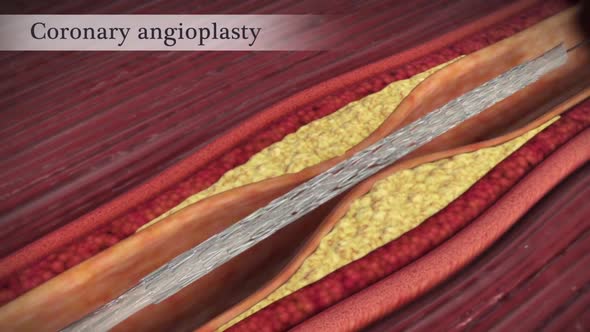 Coronary angioplasty opens narrowed coronary arteries.