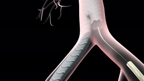 Abdominal Aortic Aneurysm Repair 3d animation