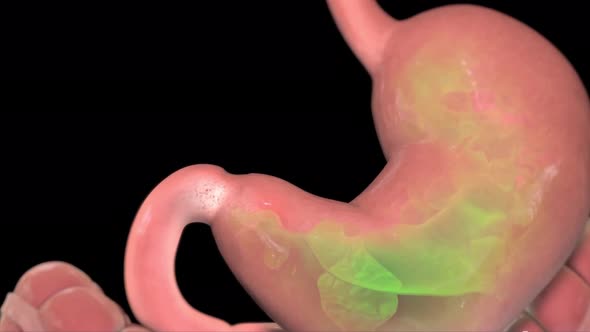 This video shows the gastroesophageal reflux
