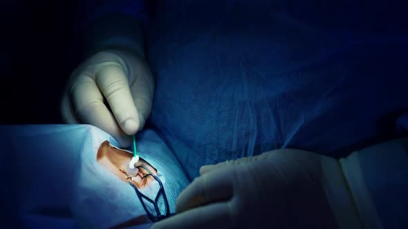 Surgeon hands performing laser eye vision correction
