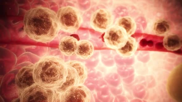 Cancer cells causing metastasis cancerous tumor - 3D animation render