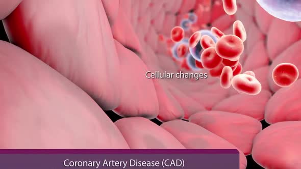 Plaque formation in the cardiovascular tract