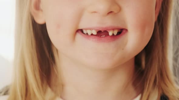 Close-up mouth child has lost two milk teeth. Replacement of permanent changing teeth, toothless