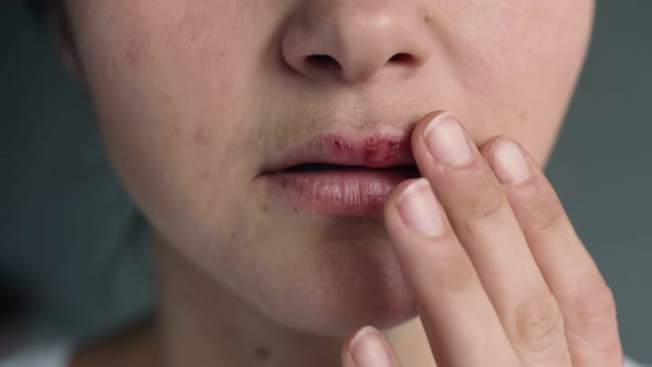 Part of the Face of a Young Woman with Lips Affected By Herpes