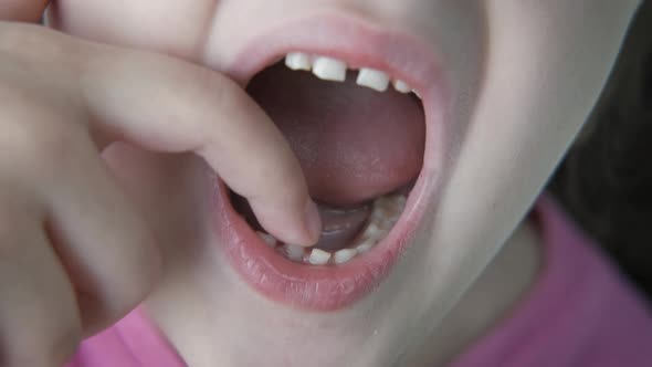 Decay of deciduous teeth. 