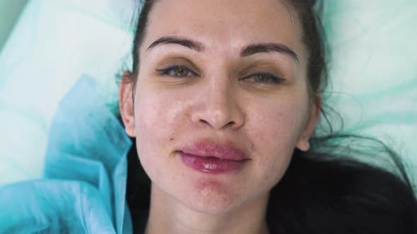 Lady with Inflamed Lips After Augmentation Procedure