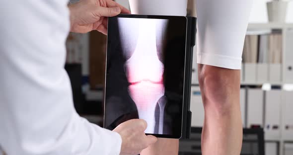 Doctor Doing Computer Examination of Knee Joint Using Digital Tablet  Movie