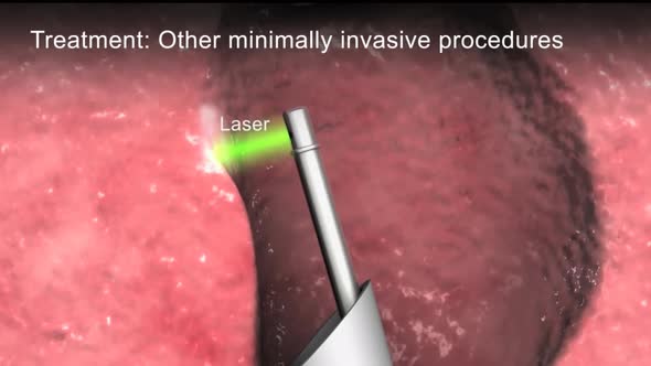 Benign Prostatic Hyperplasia 3d medical