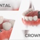 Dental Crown - VideoHive Item for Sale