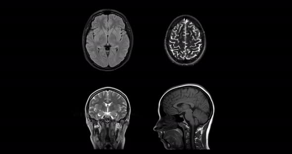 MRI of the brain in different projections. Horizontal, vertical, lateral and top view. MRI