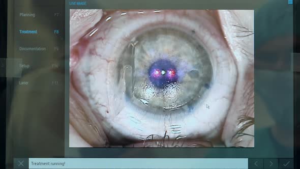 Close Up of Patient's Eye During Laser Correction
