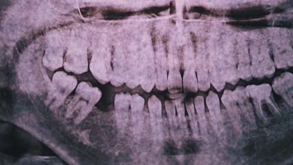 Dental X-Ray of the Jaw with Teeth Against the Light. Sealed Molars. Radiography