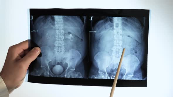 X Ray Of The Kidneys, X Ray Of A Kidney With A Stone. Doctor Analyzes Oxalate Kidney Stone