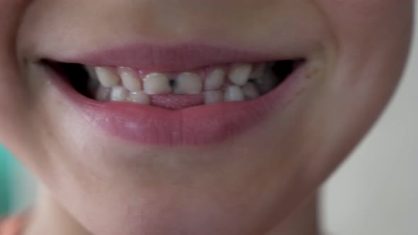 Close Up Little Child Show Broken Teeth Boy with a Teeth Broken and Caries