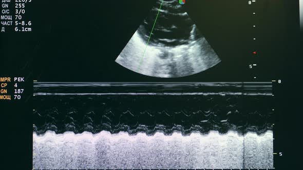 Ultrasound Screening of a Baby Heart.