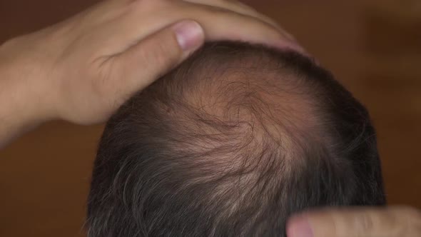 Male Pattern Baldness, Thinning Crown