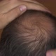 Male Pattern Baldness, Thinning Crown - VideoHive Item for Sale