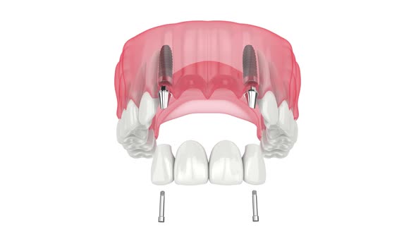 Upper jaw with dental bridge supported by implants